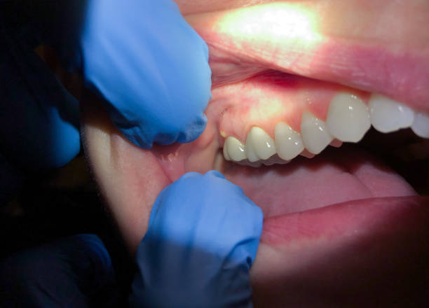 Best Emergency Treatment for Toothache in Saddlebrooke, AZ